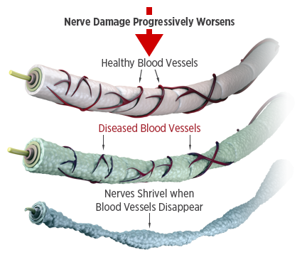 Neuropathy Foot Pain